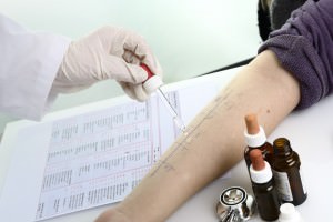 Arzt tropft Allergietest Pricktest auf Unterarm